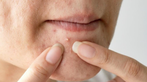  Dùng nhiều đường tinh chế thường xuyên có thể làm tăng nguy cơ bị mụn lên đến 30%